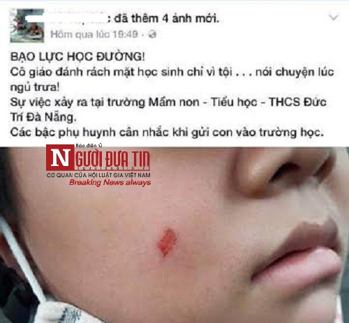 Dân sinh - HS bị cô giáo cào rách má vì không ngủ trưa: Nhà trường lên tiếng