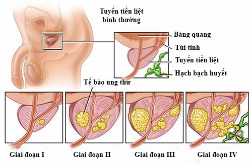 Các bệnh - 4 bệnh nguy hiểm quý ông rất dễ mắc ở tuổi 30