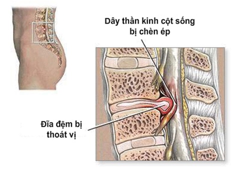 Thương hiệu - Điều trị thoát vị đĩa đệm cột sống như thế nào? (Hình 2).