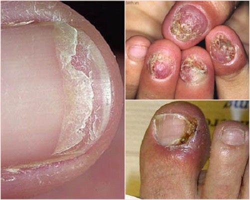 C&aacute;c bệnh - 3 th&oacute;i quen xấu khiến tay ch&acirc;n bị hủy hoại v&agrave; biến dạng khủng khiếp (H&igrave;nh 5).