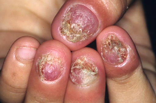 C&aacute;c bệnh - 3 th&oacute;i quen xấu khiến tay ch&acirc;n bị hủy hoại v&agrave; biến dạng khủng khiếp (H&igrave;nh 8).