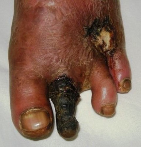 C&aacute;c bệnh - 3 th&oacute;i quen xấu khiến tay ch&acirc;n bị hủy hoại v&agrave; biến dạng khủng khiếp