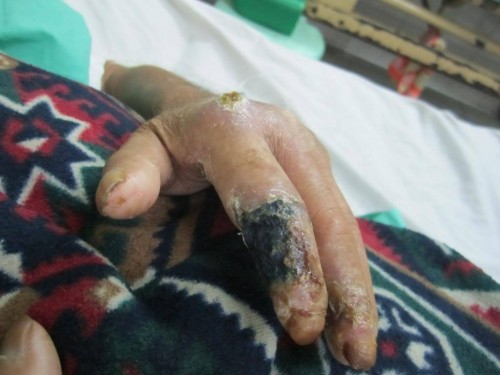 C&aacute;c bệnh - 3 th&oacute;i quen xấu khiến tay ch&acirc;n bị hủy hoại v&agrave; biến dạng khủng khiếp (H&igrave;nh 4).