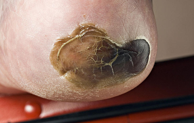 C&aacute;c bệnh - 3 th&oacute;i quen xấu khiến tay ch&acirc;n bị hủy hoại v&agrave; biến dạng khủng khiếp (H&igrave;nh 10).