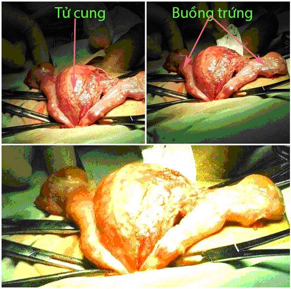 Các bệnh - Chuyện hiếm gặp ở VN: Người đàn ông có tử cung và buồng trứng