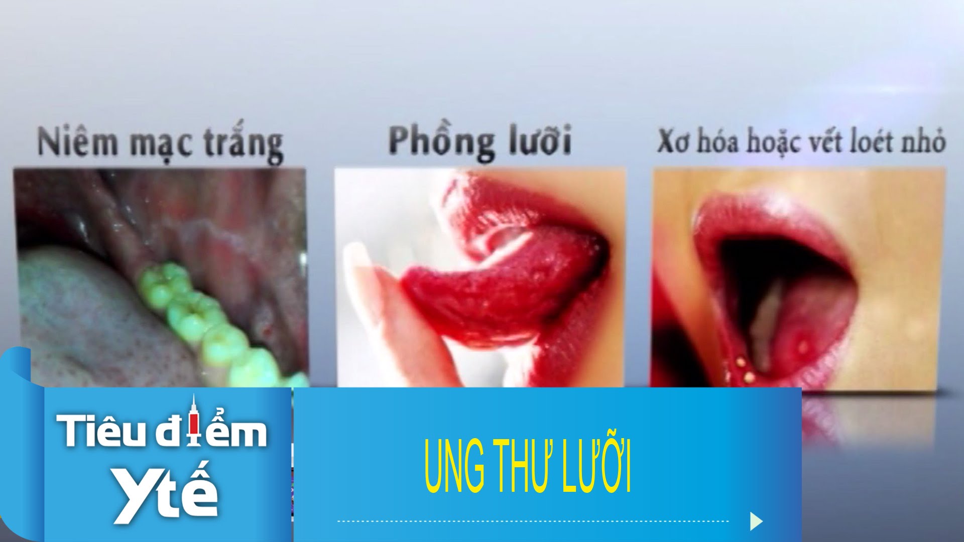 Các bệnh - Dấu hiệu nào ‘tố’ bạn đang mắc bệnh ung thư lưỡi (Hình 2).