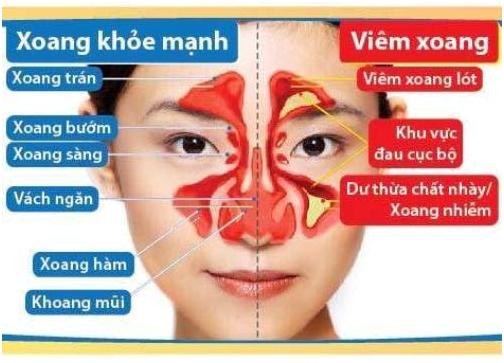 Thương hiệu - Hết viêm xoang nhờ bài thuốc trăm năm tuổi của lương y dân tộc Mường (Hình 3).