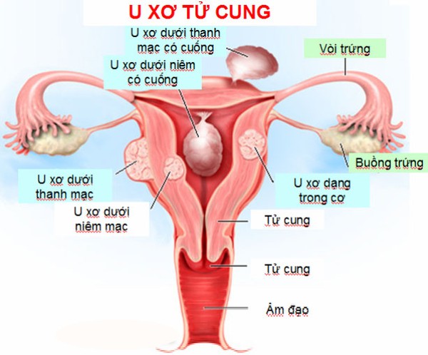 Các bệnh - Đau bụng dưới đang ‘tố’ bạn mắc 1 trong 5 bệnh cực kỳ nguy hiểm (Hình 2).