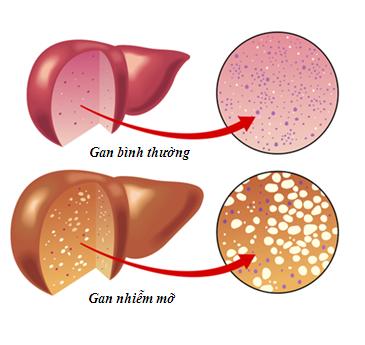 Các bệnh - Bệnh gan nhiễm mỡ và những điều cần biết