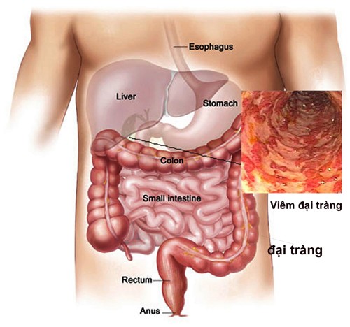 Các bệnh - Những món ăn đưa con người tới gần hơn với ung thư đại trực tràng