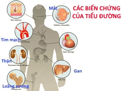 Các bệnh - Dấu hiệu nhận biết căn bệnh ‘giết người thầm lặng’ đái tháo đường (Hình 2).