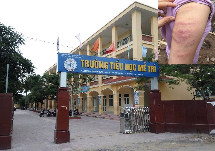 Giáo dục - Hà Nội: Cô giáo đánh tím bầm tay học sinh, thầy Hiệu trưởng nói gì? (Hình 3).