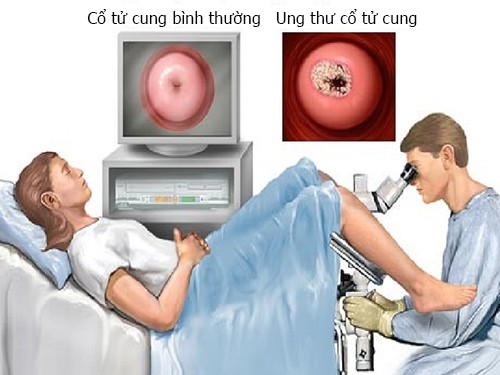 Các bệnh - Dấu hiệu sớm của ung thư cổ tử cung