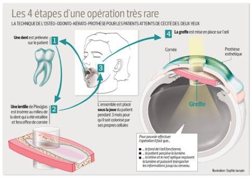 Các bệnh - 'Xóa' mù nhờ cấy răng vào mắt