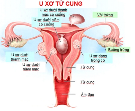 Các bệnh - Vì sao phụ nữ hay bị u xơ tử cung, xử trí thế nào?