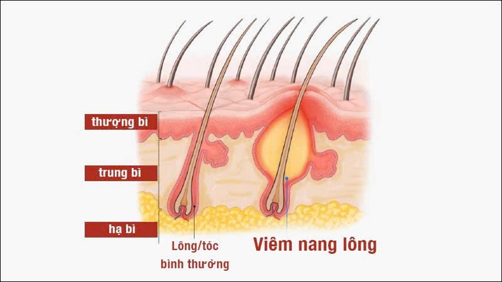 Bảo Thanh Đường – Điều trị dứt điểm bệnh viêm chân tóc- Ảnh 2.