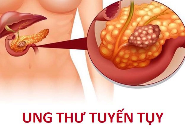 Dấu hiệu nguy hiểm ở chân cảnh báo ung thư tuyến tụy- Ảnh 2.