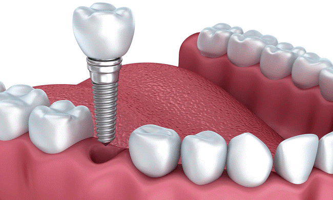 Trồng răng implant an toàn công nghệ cao tại Nha khoa Vindental - Ảnh 1.