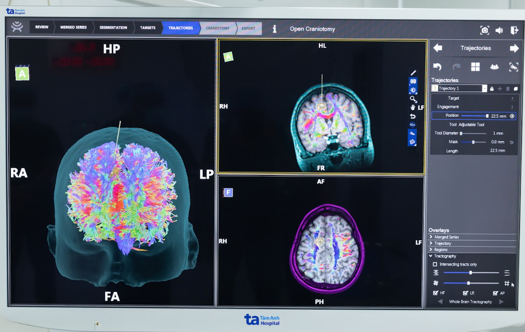 Thực hiện thành công 100 ca mổ não, tủy sống đầu tiên với Robot AI duy nhất tại Việt Nam- Ảnh 3.
