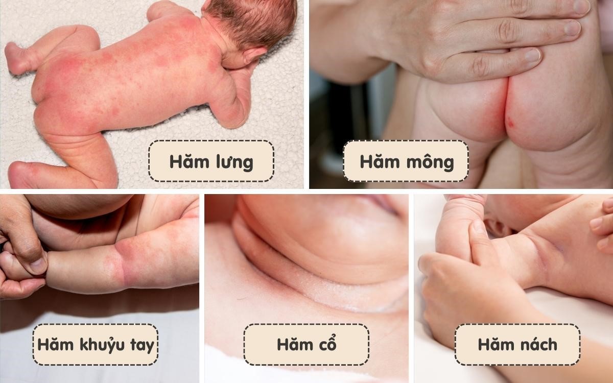 Chuyên gia y tế cảnh báo hăm tã nặng gây hậu quả khôn lường ba mẹ cần lưu ý- Ảnh 1.