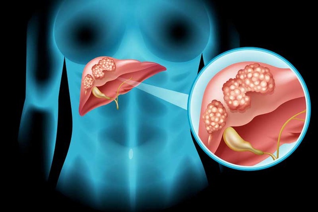 Tối ưu quá trình theo dõi và quản lý viêm gan virus B nhờ ứng dụng thông minh- Ảnh 1.