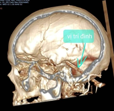 Người đàn ông bị cây đinh đâm vào não suốt một năm