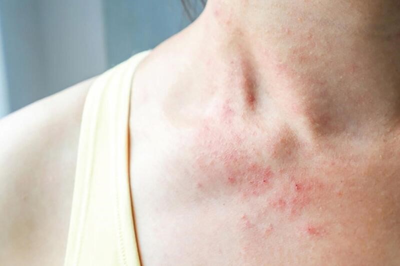 Bảo Thanh Đường địa chỉ uy tín chữa tận gốc bệnh chàm (eczema)- Ảnh 1.