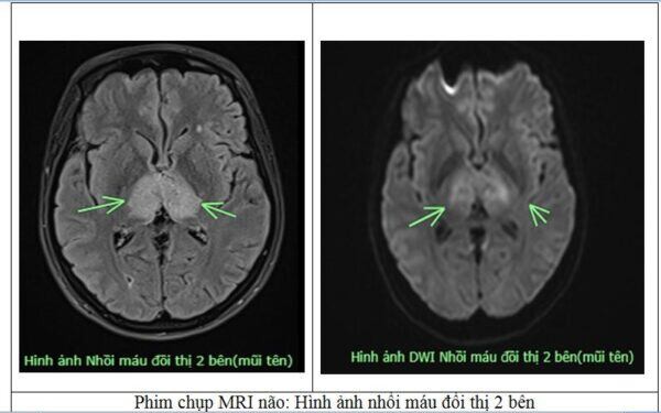 Nhiều người Việt thường mắc phải thói quen này dẫn đến đột quỵ não