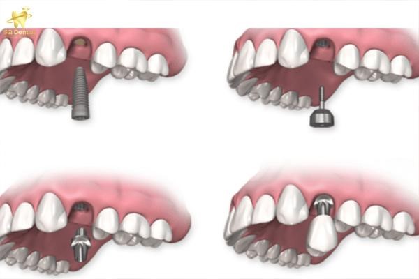 SQ Dentist - Dịch vụ trồng răng implant tốt tại TPHCM- Ảnh 3.