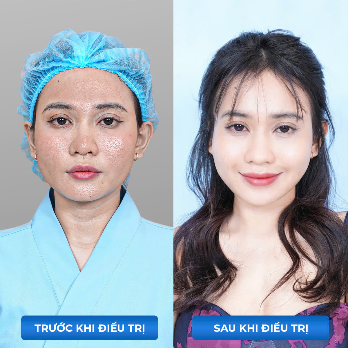 Trị nám, trẻ hoá hiệu quả không phẫu thuật cùng BSCK II Nguyễn Quốc Hưng - Nguyên giám đốc bệnh viện da liễu Hà Nội- Ảnh 3.