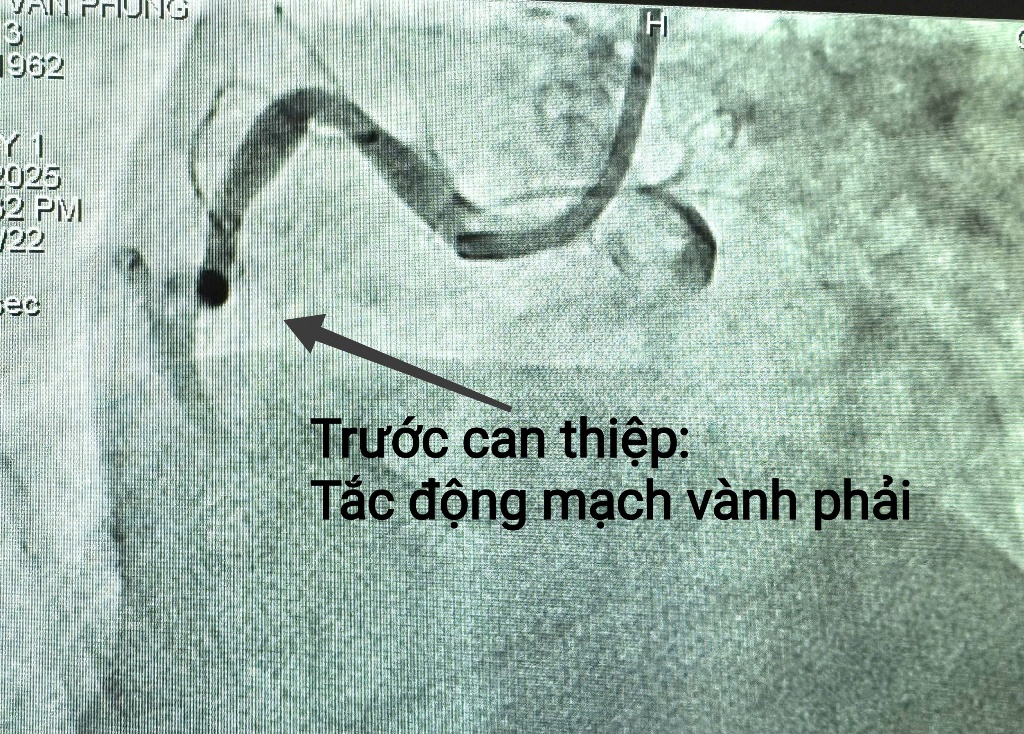 Cứu sống bệnh nhân nhồi máu cơ tim nguy kịch với viện phí 0 đồng- Ảnh 1.