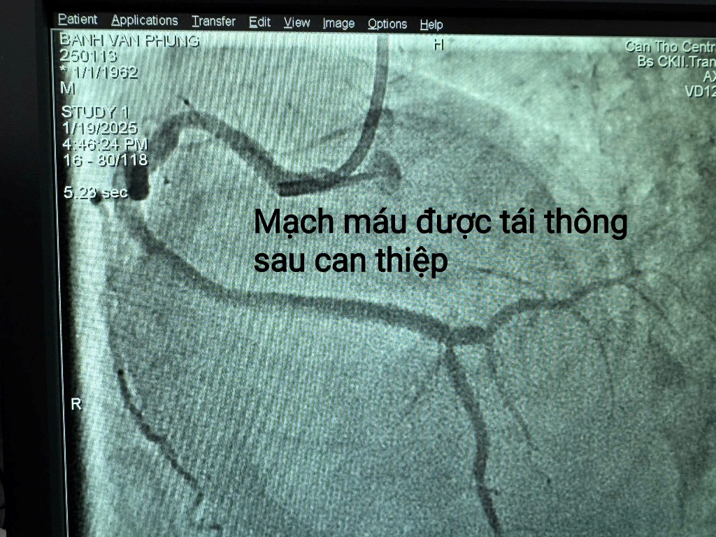 Cứu sống bệnh nhân nhồi máu cơ tim nguy kịch với viện phí 0 đồng- Ảnh 3.