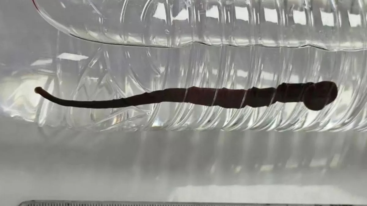 Cậu bé bất ngờ ho ra con đỉa dài 12cm khiến bác sĩ sốc nặng- Ảnh 1. Cậu bé bất ngờ ho ra con đỉa dài 12cm khiến bác sĩ sốc nặng- Ảnh 1.