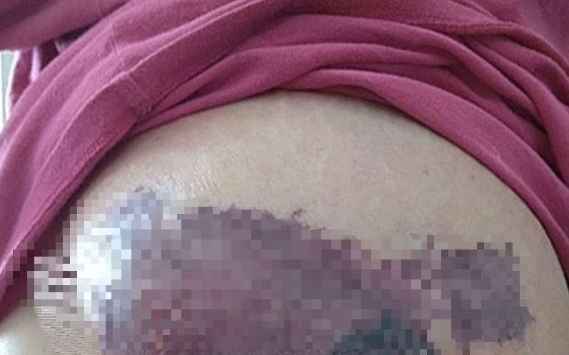 Người đàn ông 34 tuổi da bỗng tím đen, bác sĩ phát hiện "bí mật" đáng sợ - Ảnh 2.