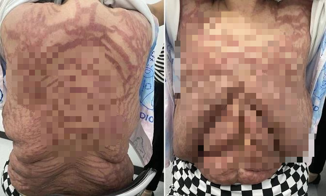 Người phụ nữ 40 tuổi, da biến dạng kinh hoàng vì sai lầm nhiều người mắc- Ảnh 2. Người phụ nữ 40 tuổi, da biến dạng kinh hoàng vì sai lầm nhiều người mắc- Ảnh 2.