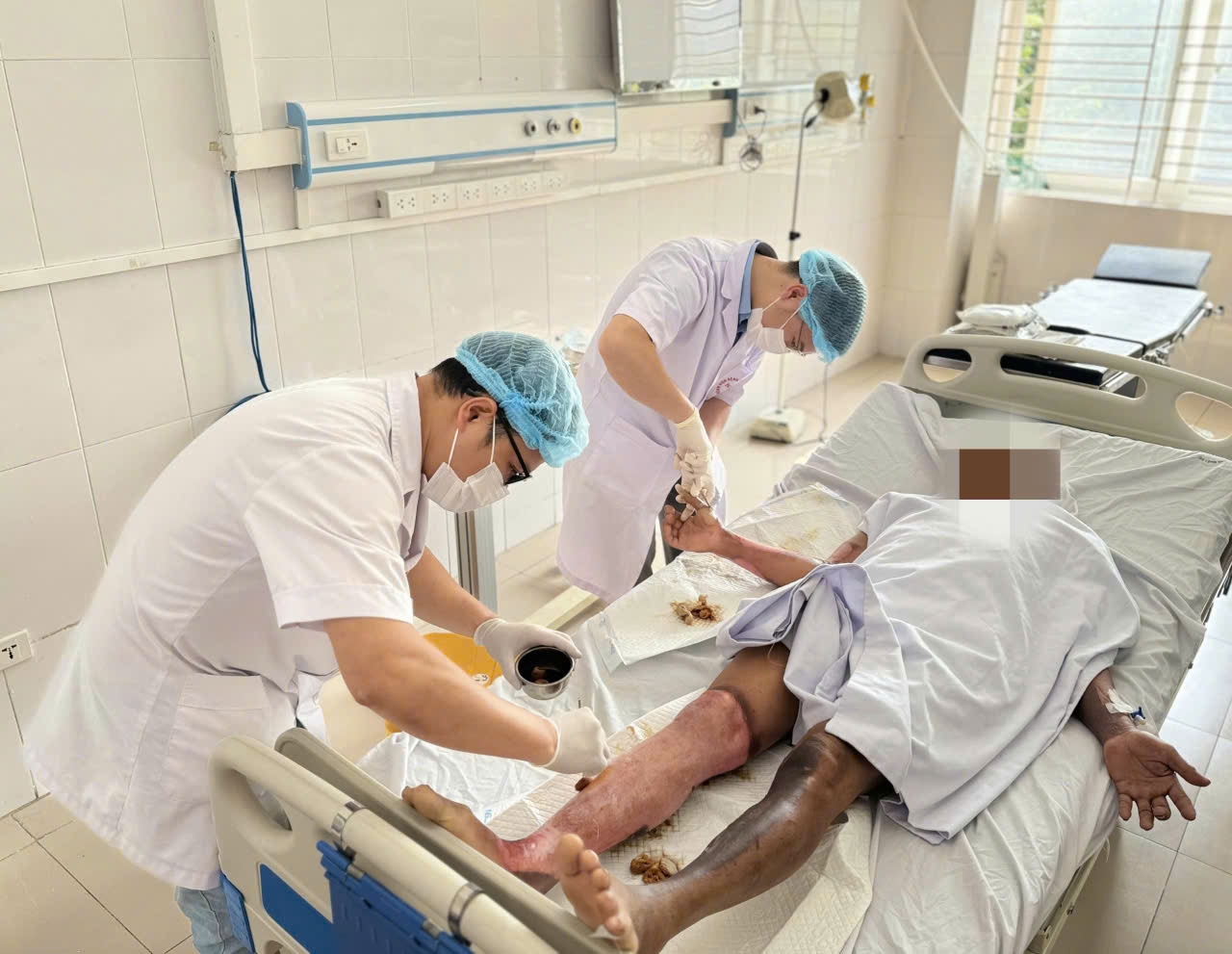 Giữ thang giúp hàng xóm, người đàn ông nhập viện với 30% cơ thể bỏng rộp - Ảnh 1.
