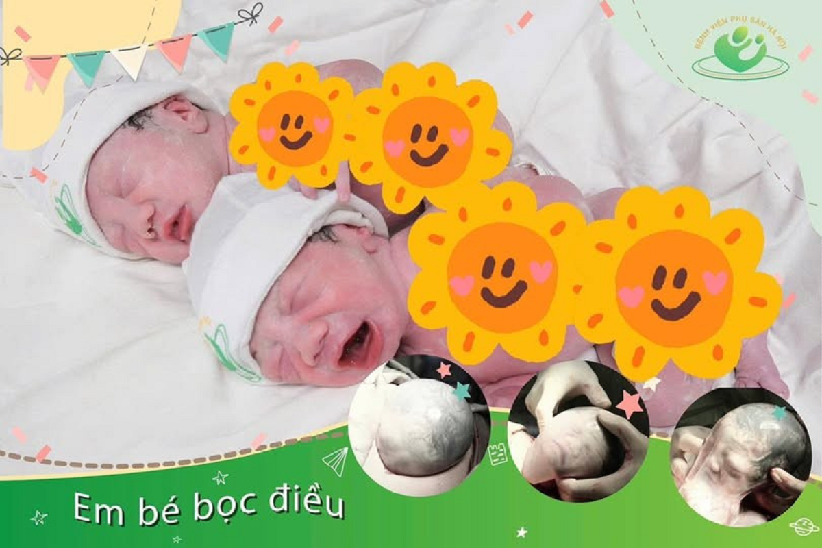 Ca sinh đôi hiếm gặp: Em bé chào đời vẫn còn nguyên vẹn trong "bọc diều"- Ảnh 1. Ca sinh đôi hiếm gặp: Em bé chào đời vẫn còn nguyên vẹn trong "bọc diều"- Ảnh 1.