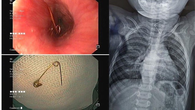Bé 1 tuổi nhập viện trong tình trạng đau đớn, bác sĩ gắp ra thứ "đáng sợ" trong bụng - Ảnh 1.