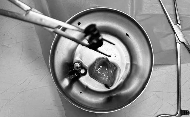 Bé trai 4 tuổi đau bụng dữ dội, nôn ói, bác sĩ gắp ra thứ "đáng sợ" bên trong- Ảnh 1.