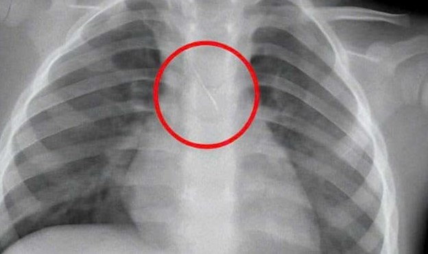 Bé trai 3 tuổi đi làm răng bị thứ đáng sợ rơi vào đường thở - Ảnh 1.