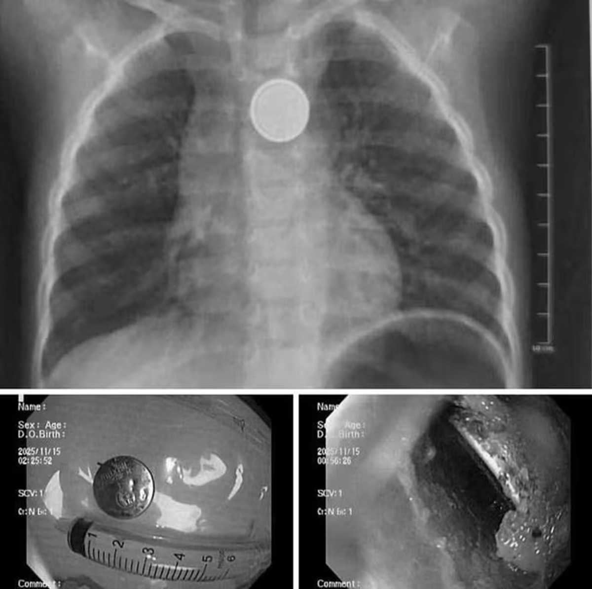 Bé trai bị loét sâu thực quản, bác sĩ gắp ra thứ "đáng sợ" bên trong - Ảnh 1.