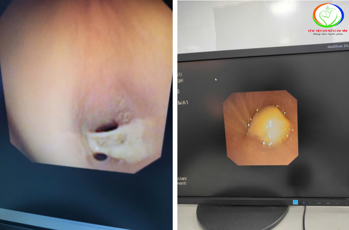 Bé trai hơn 2 tuổi xẹp phổi vì nuốt phải thứ hạt "vạn người mê" - Ảnh 2.