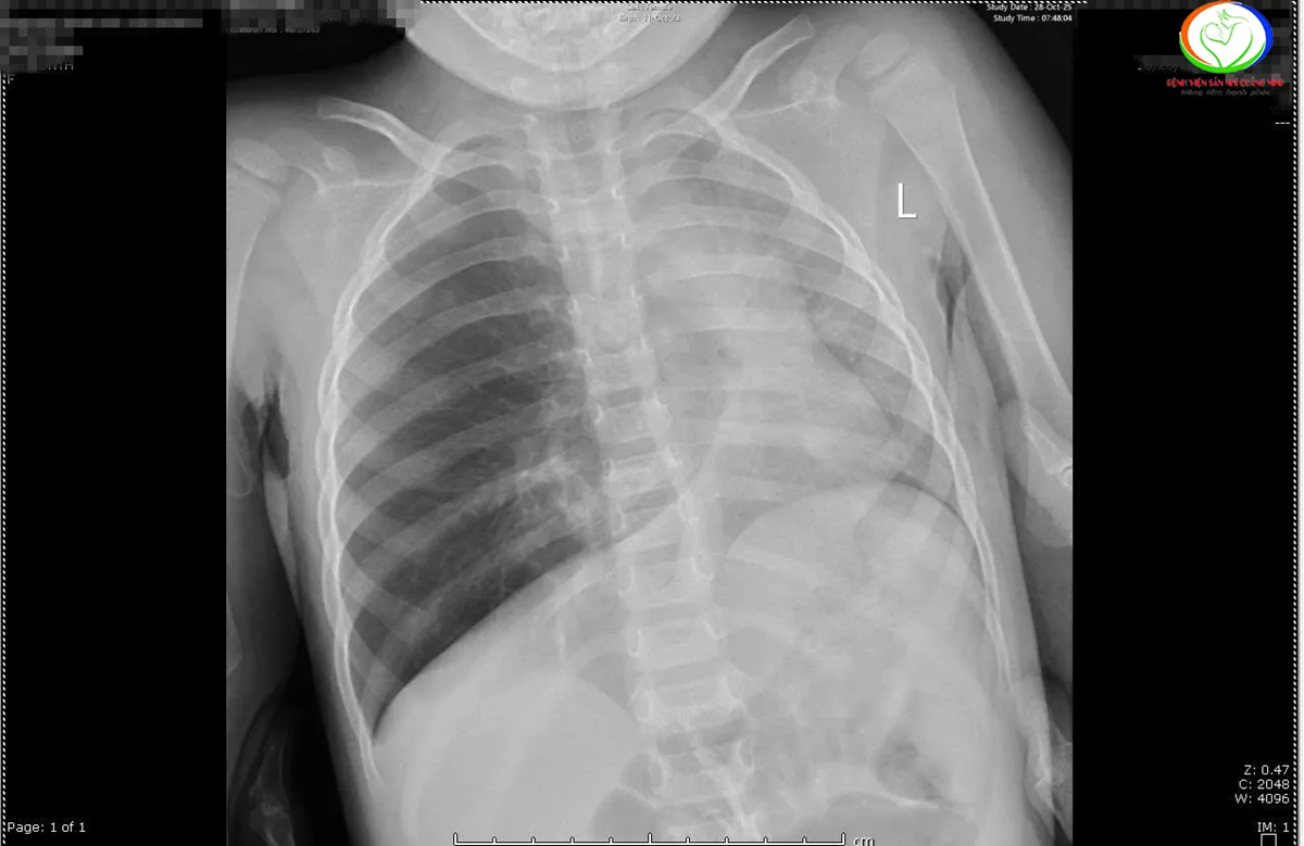 Bé trai hơn 2 tuổi xẹp phổi vì nuốt phải thứ hạt "vạn người mê" - Ảnh 1.