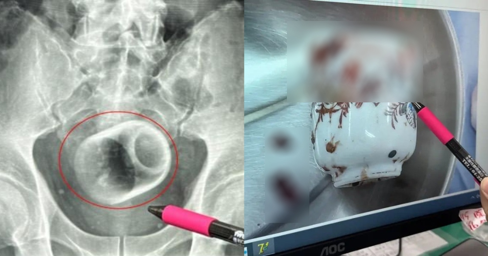 Người đàn ông bị chướng bụng, bác sĩ phát hiện ra bí mật đáng sợ- Ảnh 1.