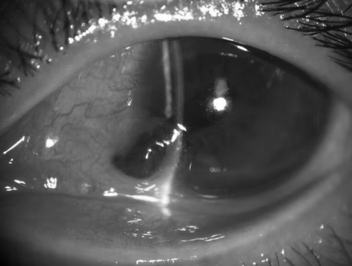 Người đàn ông 27 tuổi đau mắt dữ dội, bác sĩ gắp ra thứ "đáng sợ" bên trong - Ảnh 1.