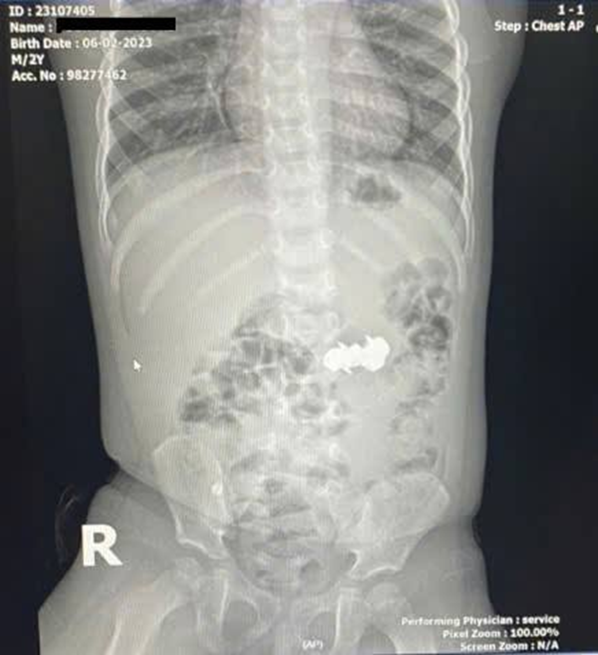 Bé trai 2 tuổi được gia đình đưa đi viện, bác sĩ gắp ra thứ "đáng sợ" bên trong - Ảnh 1.