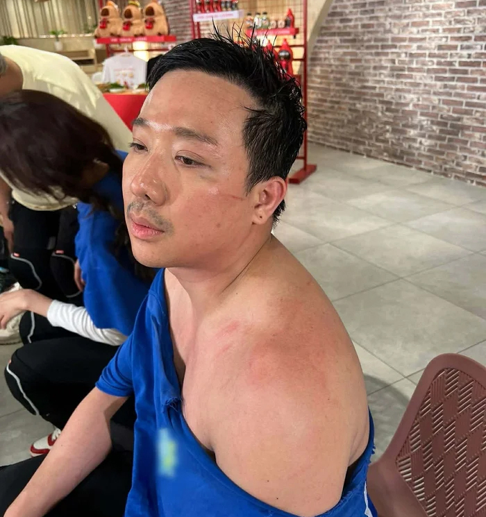 Lộ ảnh Trấn Thành bị bầm dập, tả tơi khiến fan xót xa - Ảnh 3.