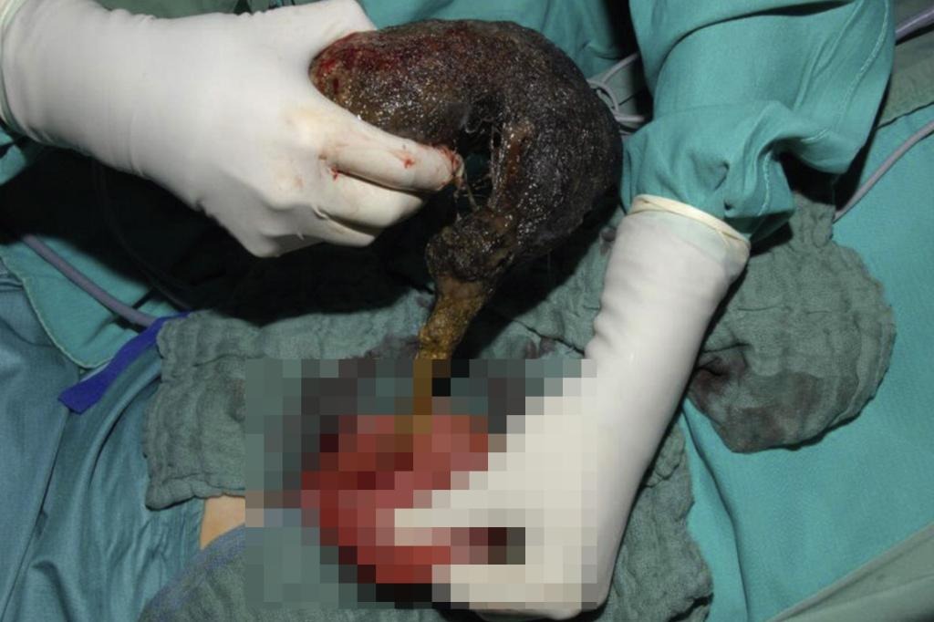 Bé gái đau bụng suốt 10 tháng, bác sĩ phát hiện ra "bí mật" đáng sợ - Ảnh 1.