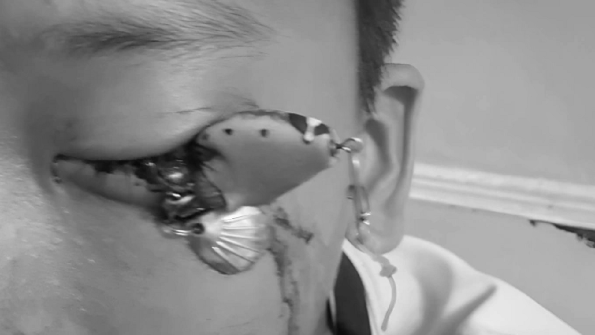 Bé trai 12 tuổi đau mắt dữ dội, bác sĩ gắp ra thứ "đáng sợ" bên trong- Ảnh 1.