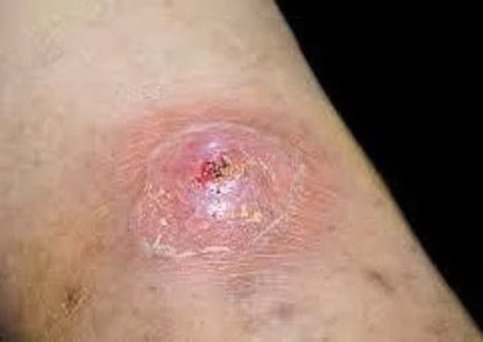 Người đàn ông suýt mất mạng vì vi khuẩn hiếm gặp trong bùn đất sau lũ - Ảnh 4.